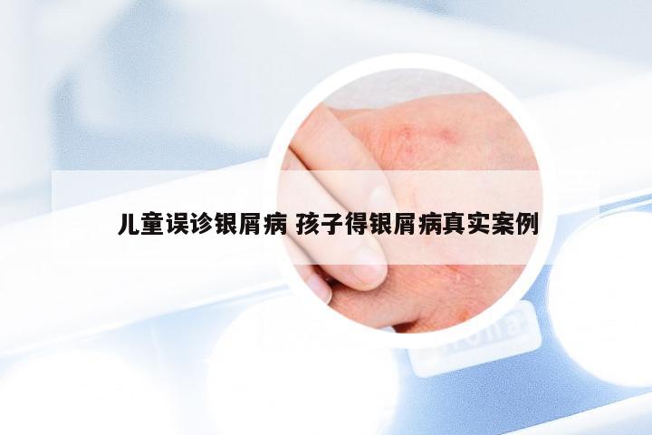 儿童误诊银屑病 孩子得银屑病真实案例