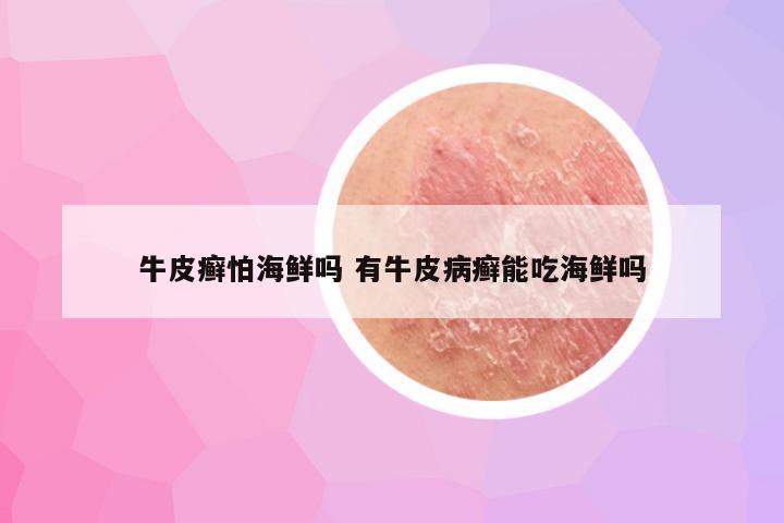 牛皮癣怕海鲜吗 有牛皮病癣能吃海鲜吗