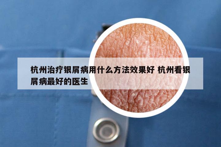 杭州治疗银屑病用什么方法效果好 杭州看银屑病最好的医生