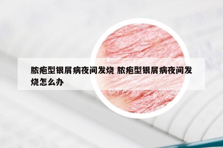 脓疱型银屑病夜间发烧 脓疱型银屑病夜间发烧怎么办