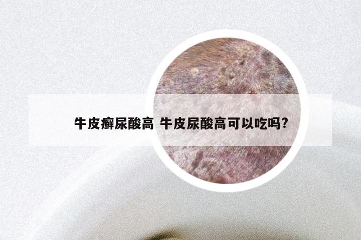 牛皮癣尿酸高 牛皮尿酸高可以吃吗?