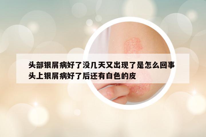 头部银屑病好了没几天又出现了是怎么回事 头上银屑病好了后还有白色的皮