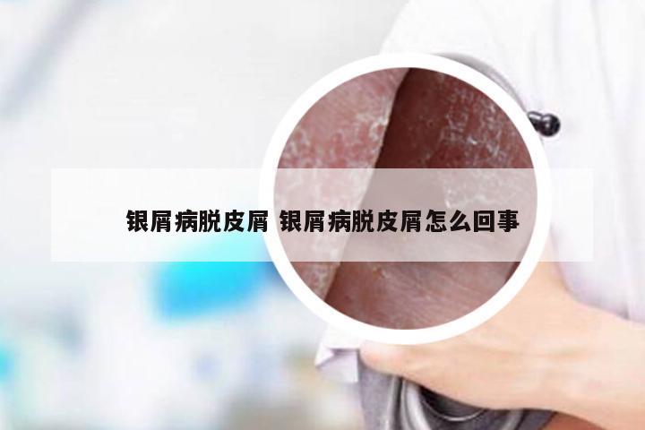 银屑病脱皮屑 银屑病脱皮屑怎么回事