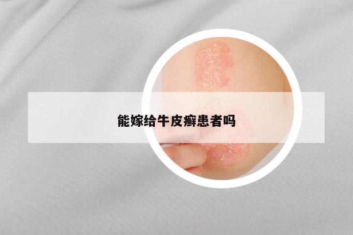 能嫁给牛皮癣患者吗