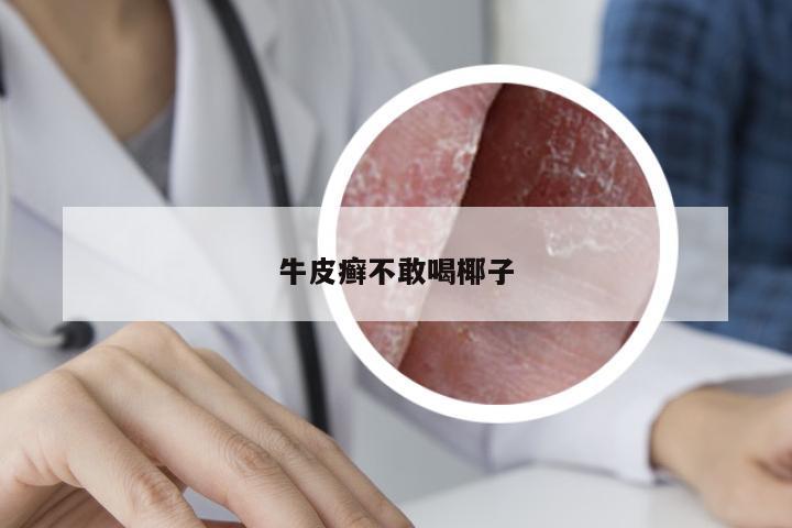 牛皮癣不敢喝椰子