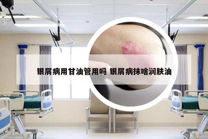 银屑病用甘油管用吗 银屑病抹啥润肤油