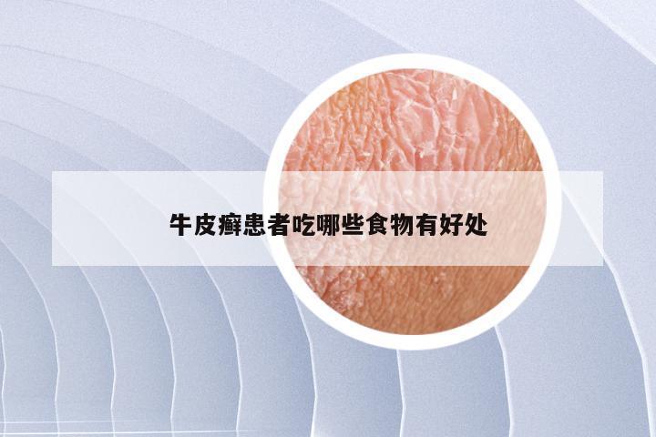 牛皮癣患者吃哪些食物有好处