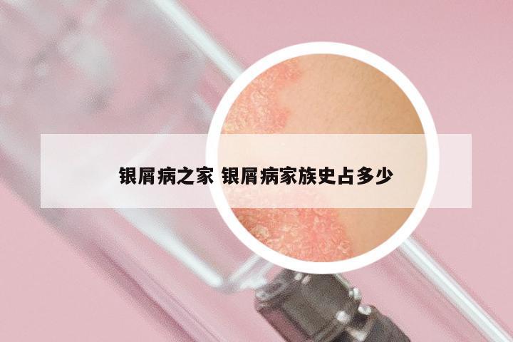 银屑病之家 银屑病家族史占多少