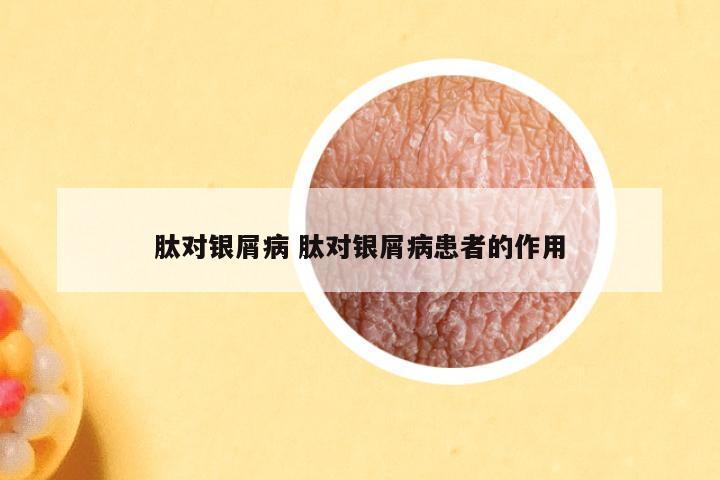 肽对银屑病 肽对银屑病患者的作用