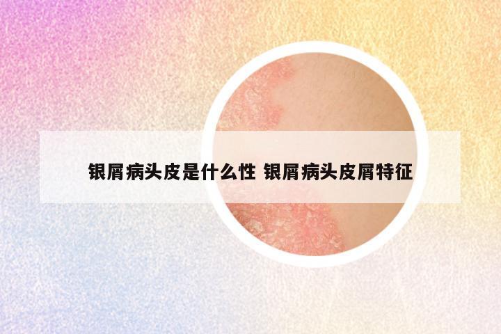 银屑病头皮是什么性 银屑病头皮屑特征