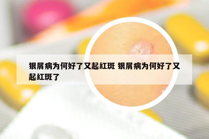 银屑病为何好了又起红斑 银屑病为何好了又起红斑了