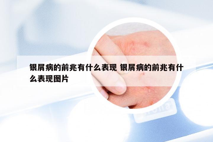 银屑病的前兆有什么表现 银屑病的前兆有什么表现图片