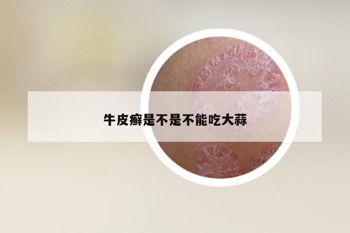 牛皮癣是不是不能吃大蒜