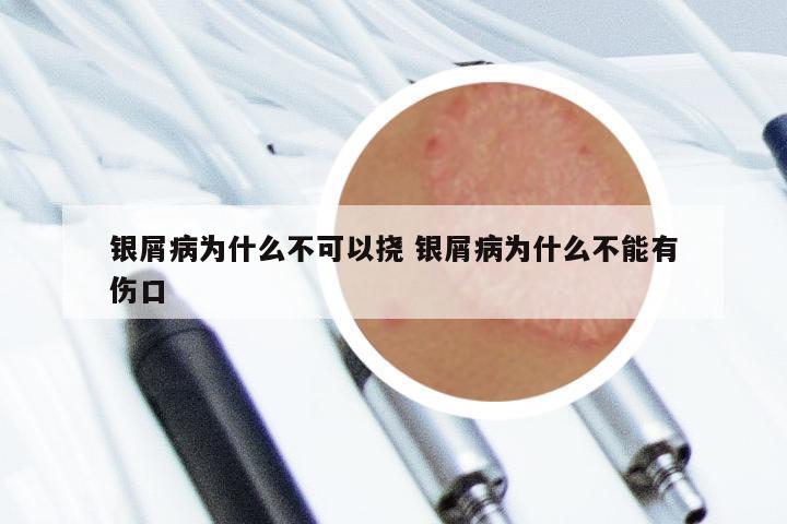 银屑病为什么不可以挠 银屑病为什么不能有伤口