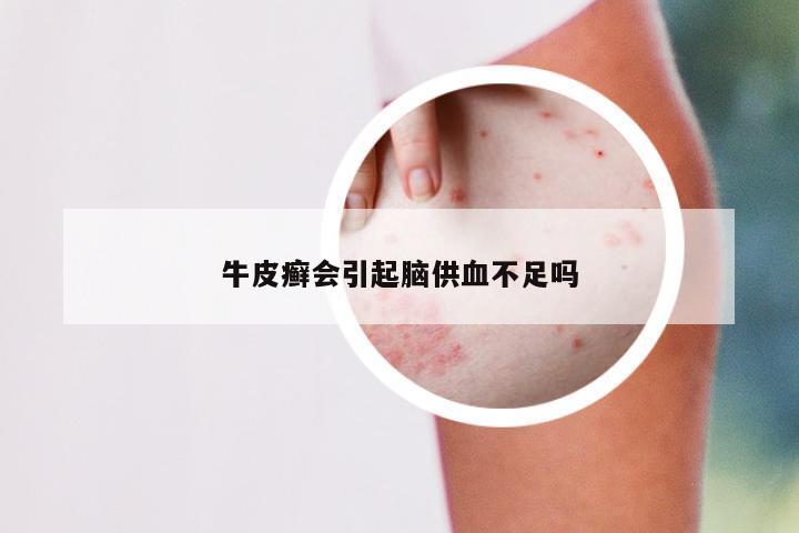 牛皮癣会引起脑供血不足吗