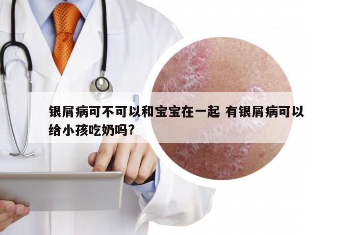 银屑病可不可以和宝宝在一起 有银屑病可以给小孩吃奶吗?