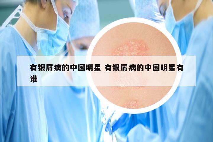 有银屑病的中国明星 有银屑病的中国明星有谁