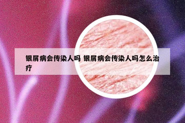 银屑病会传染人吗 银屑病会传染人吗怎么治疗