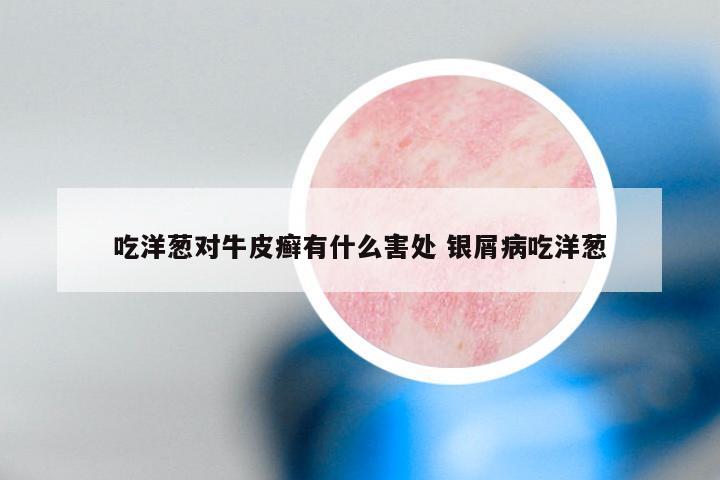 吃洋葱对牛皮癣有什么害处 银屑病吃洋葱