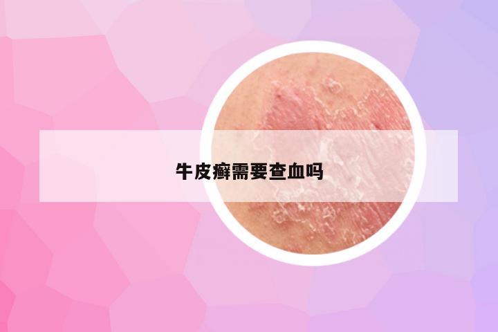 牛皮癣需要查血吗
