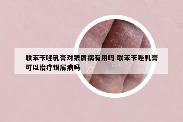 联苯苄唑乳膏对银屑病有用吗 联苯苄唑乳膏可以治疗银屑病吗