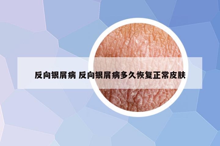 反向银屑病 反向银屑病多久恢复正常皮肤