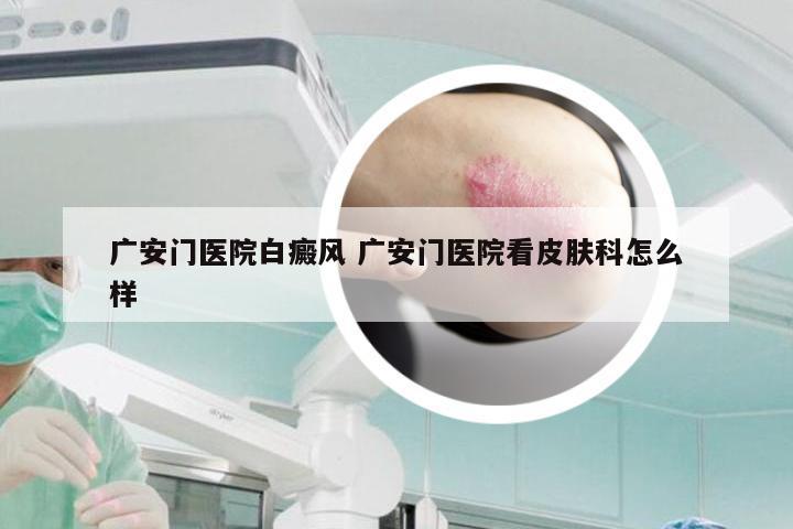 广安门医院白癜风 广安门医院看皮肤科怎么样