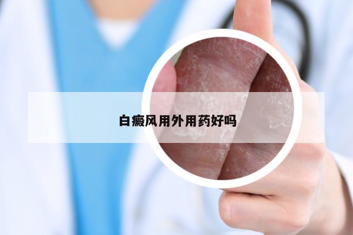白癜风用外用药好吗