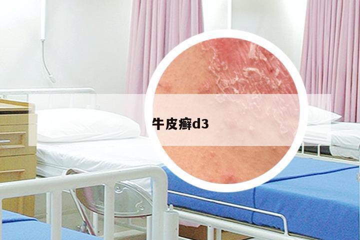牛皮癣d3