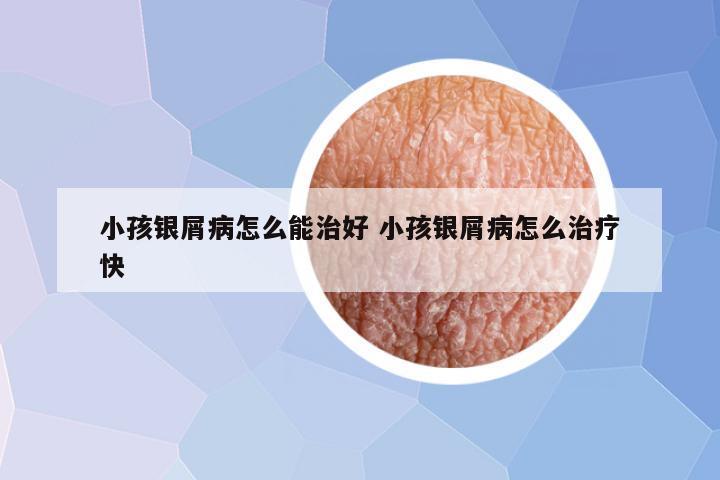 小孩银屑病怎么能治好 小孩银屑病怎么治疗快