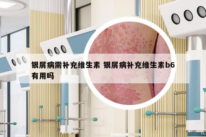 银屑病需补充维生素 银屑病补充维生素b6有用吗