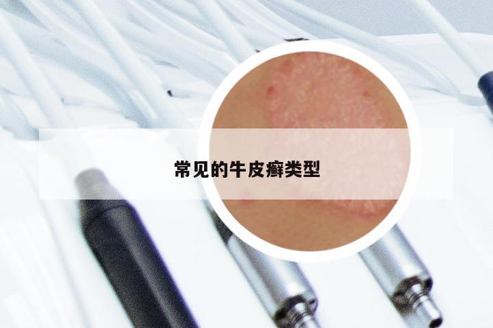 常见的牛皮癣类型