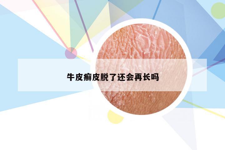 牛皮癣皮脱了还会再长吗