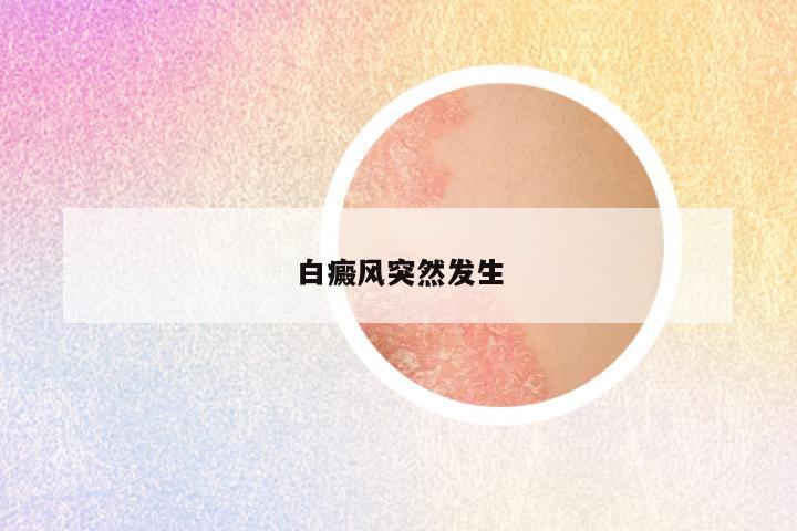 白癜风突然发生
