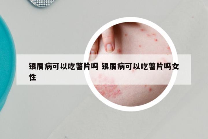 银屑病可以吃薯片吗 银屑病可以吃薯片吗女性