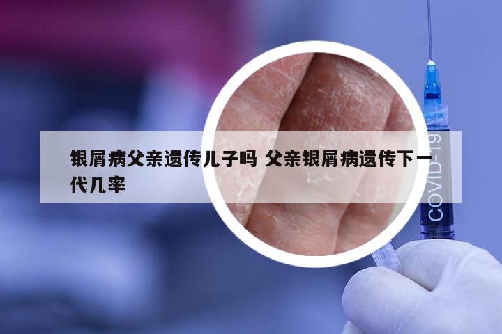 银屑病父亲遗传儿子吗 父亲银屑病遗传下一代几率