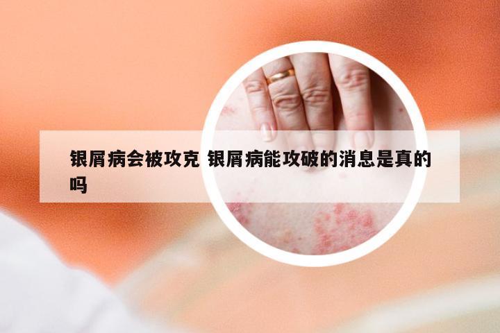 银屑病会被攻克 银屑病能攻破的消息是真的吗