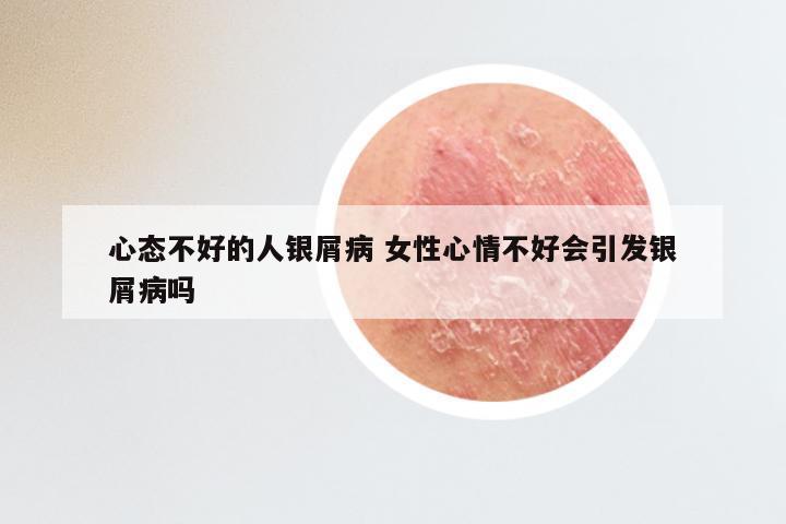 心态不好的人银屑病 女性心情不好会引发银屑病吗