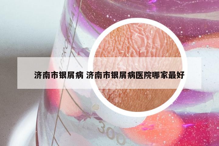 济南市银屑病 济南市银屑病医院哪家最好