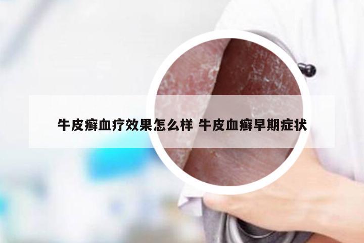 牛皮癣血疗效果怎么样 牛皮血癣早期症状