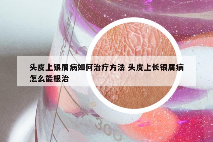 头皮上银屑病如何治疗方法 头皮上长银屑病怎么能根治
