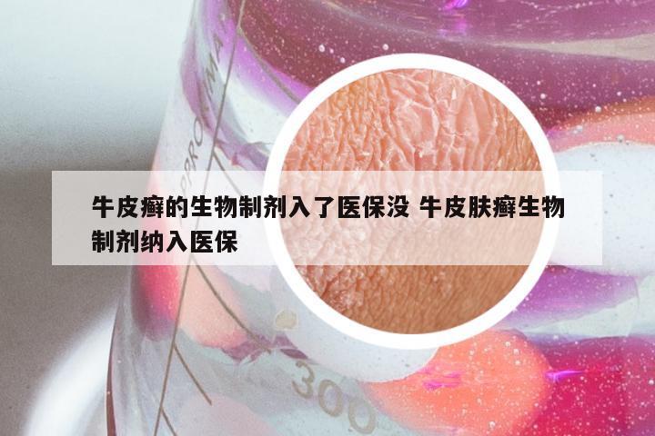 牛皮癣的生物制剂入了医保没 牛皮肤癣生物制剂纳入医保