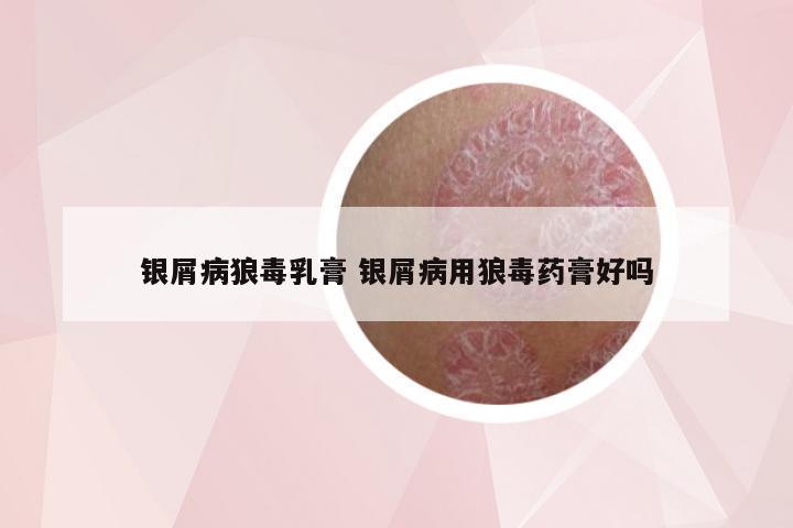 银屑病狼毒乳膏 银屑病用狼毒药膏好吗