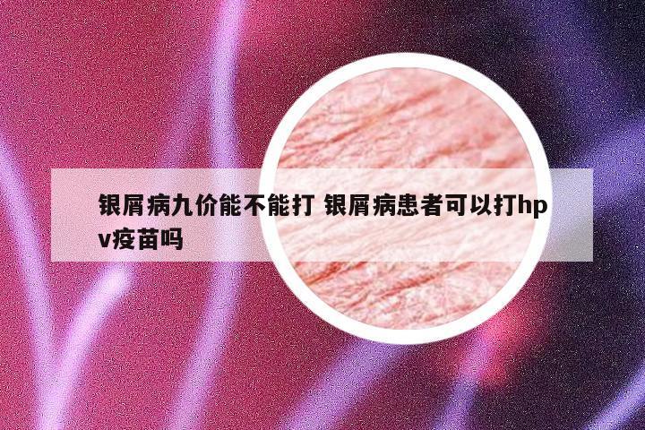 银屑病九价能不能打 银屑病患者可以打hpv疫苗吗