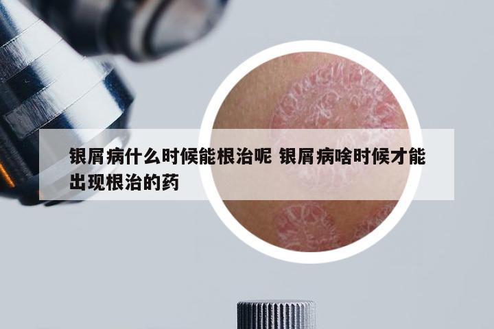 银屑病什么时候能根治呢 银屑病啥时候才能出现根治的药