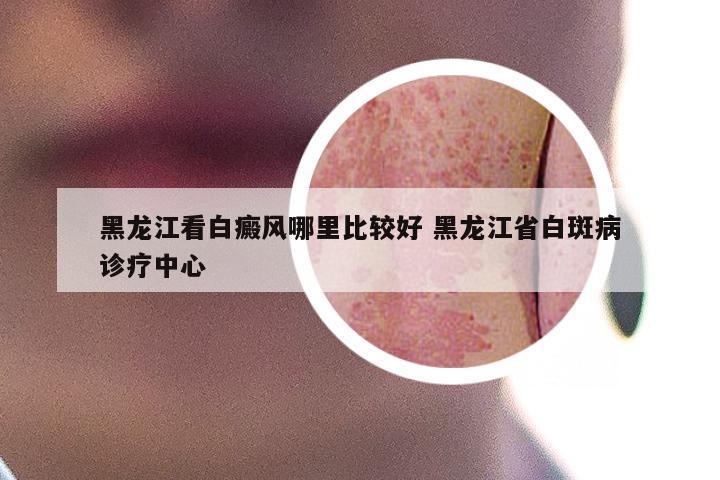 黑龙江看白癜风哪里比较好 黑龙江省白斑病诊疗中心