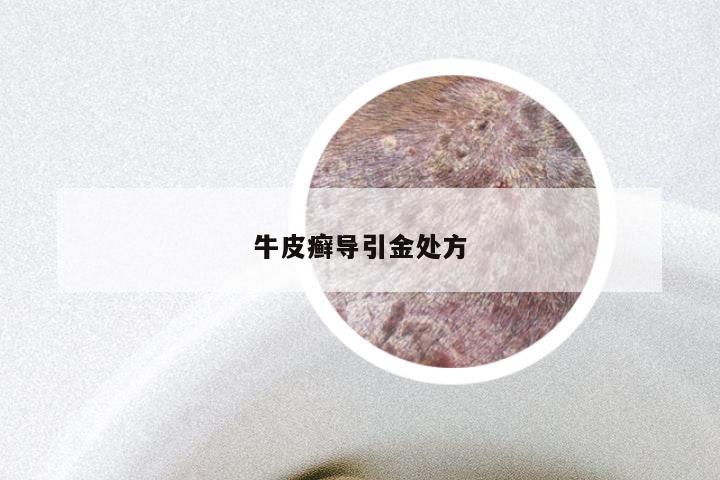 牛皮癣导引金处方