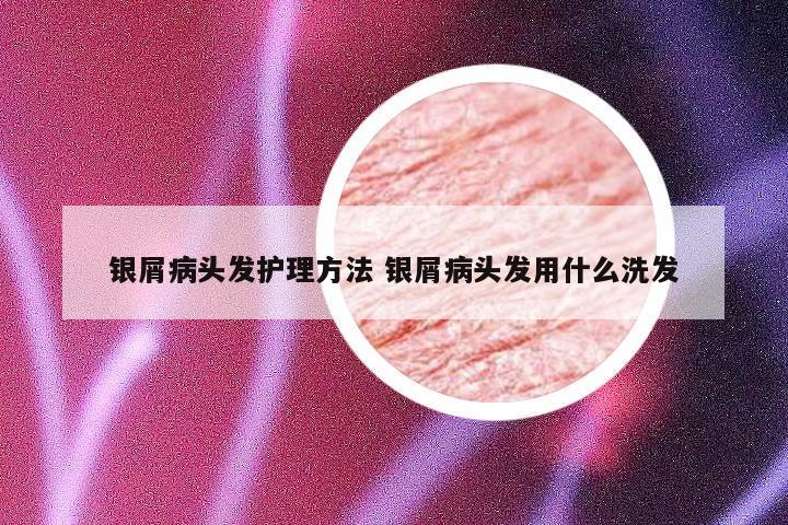 银屑病头发护理方法 银屑病头发用什么洗发