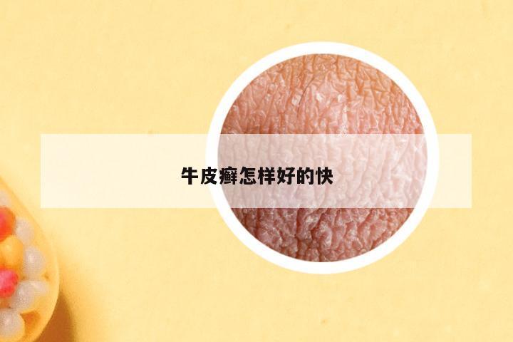 牛皮癣怎样好的快