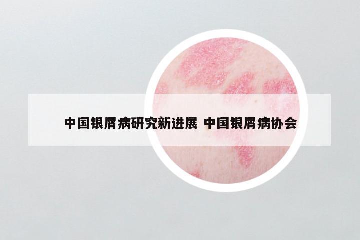 中国银屑病研究新进展 中国银屑病协会